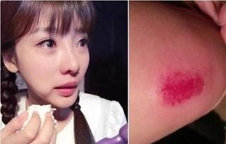 明星 受伤,康复之路备受关注